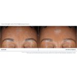 Extra Strength Active Peel Brightening System